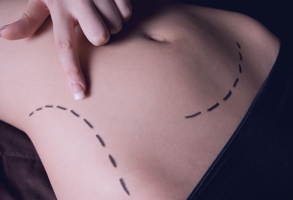 Uma imagem que ilustra uma barriga feminina com traços desenhados para realizar uma cirurgia.