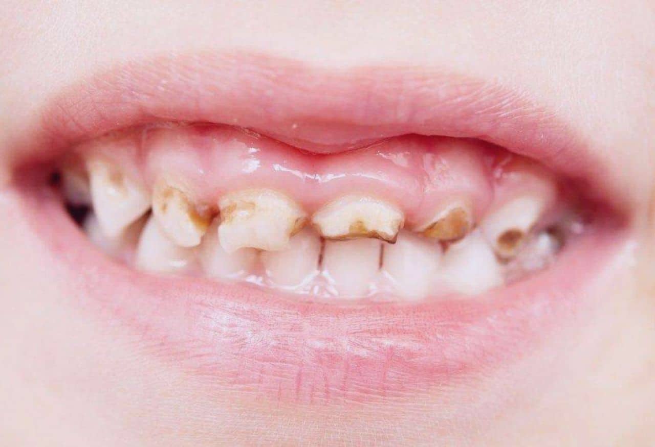 Sonhar com dente caindo significa morte? Veja significado bíblico e entenda